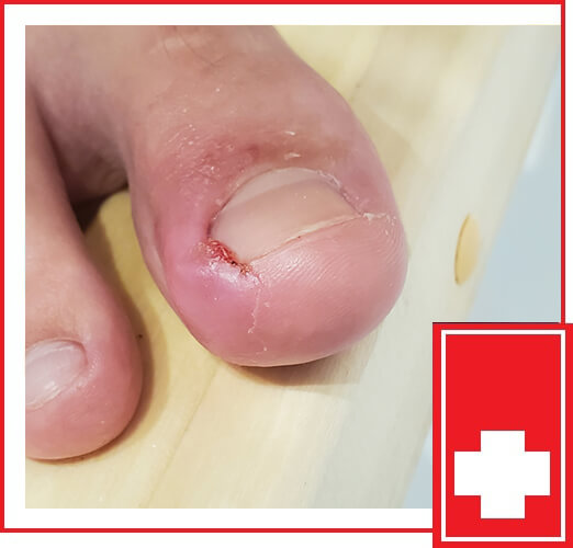 How to Get Rid of an Ingrown Fingernail