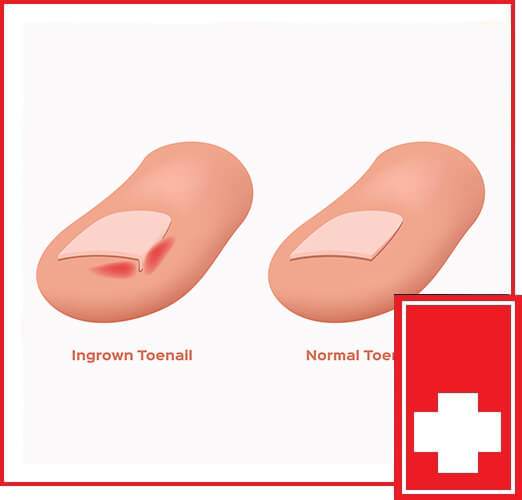 SYMPTOMS OF INGROWN TOENAILS