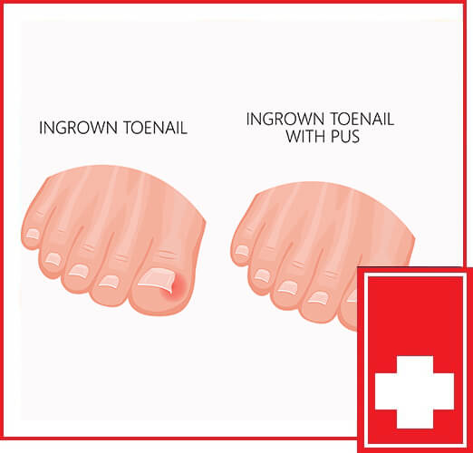 Ingrown Toenail | Wilmington Urgent Care And Family Clinic