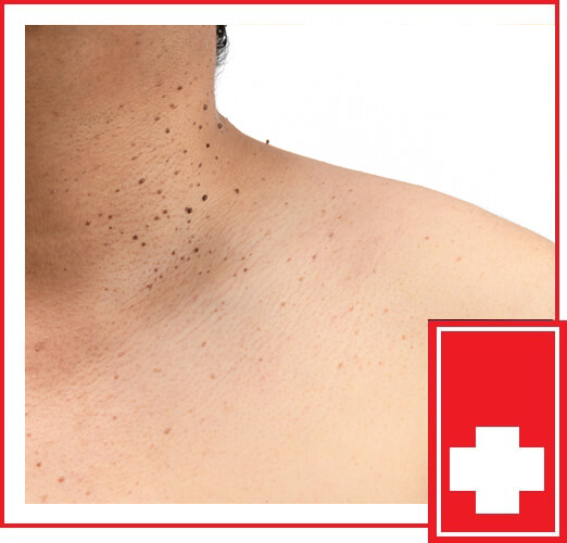 SYMPTOMS OF SKIN TAG