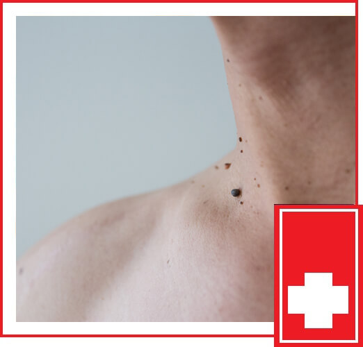 WHAT IS A SKIN TAG REMOVAL?