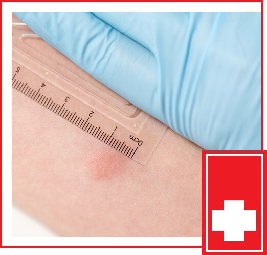 What Does A Positive TB Skin Test Look Like 53 OFF